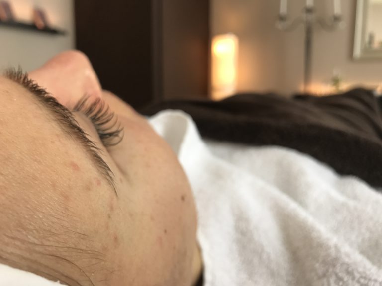 Die Wichtigkeit eines Hautpeelings – Bei unreiner Haut